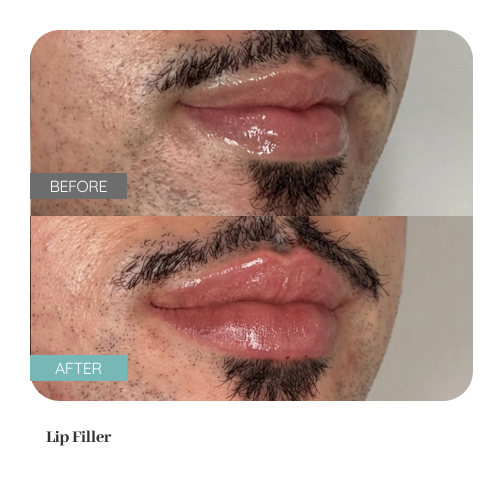 Before and after treatment result — Dr. Lanna, LC Medical Aesthetics NYC